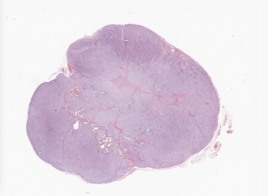 panJackson3's tweet photo. Neck dissection in pt with a thyroid mass. Any stain to prove it? #PathTwitter https://t.co/jnhgg5xUQ7