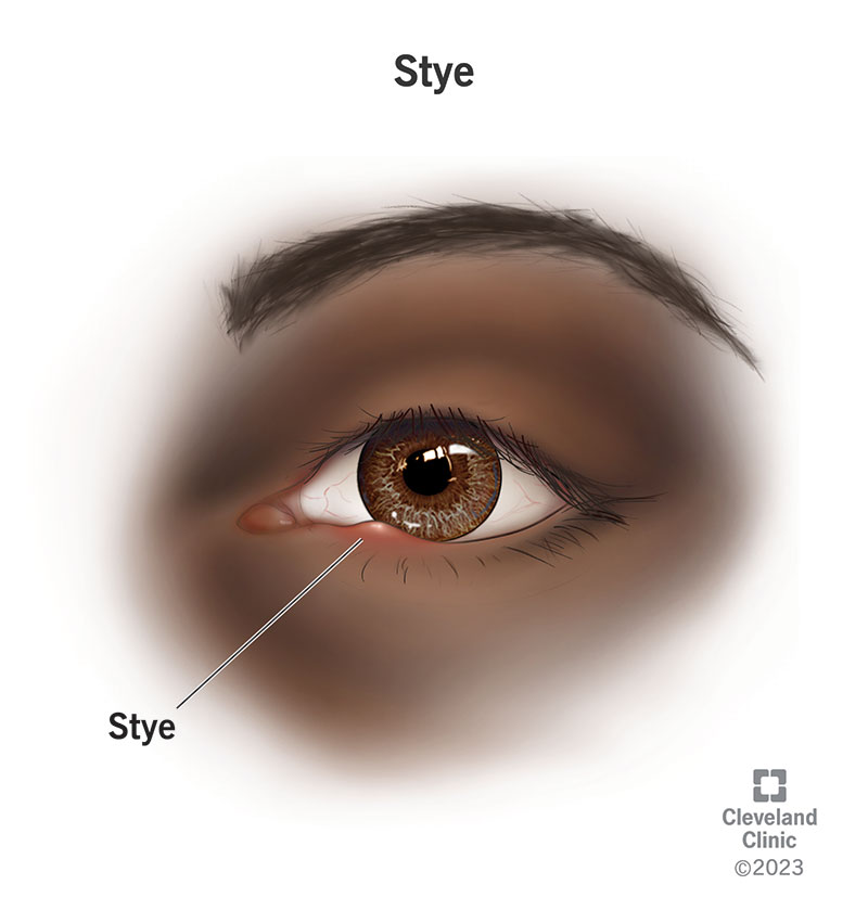 healthprefectt's tweet photo. "Got a Painful Bump on Your Eyelid? It Might Be a Stye!"

A stye, or hordeolum, is a common eye condition that results in a painful red bump on the edge of the eyelid, often near the eyelashes. 

Let’s break down what causes a stye, its symptoms, and how to manage it safely. https://t.co/x46vrXjyjW