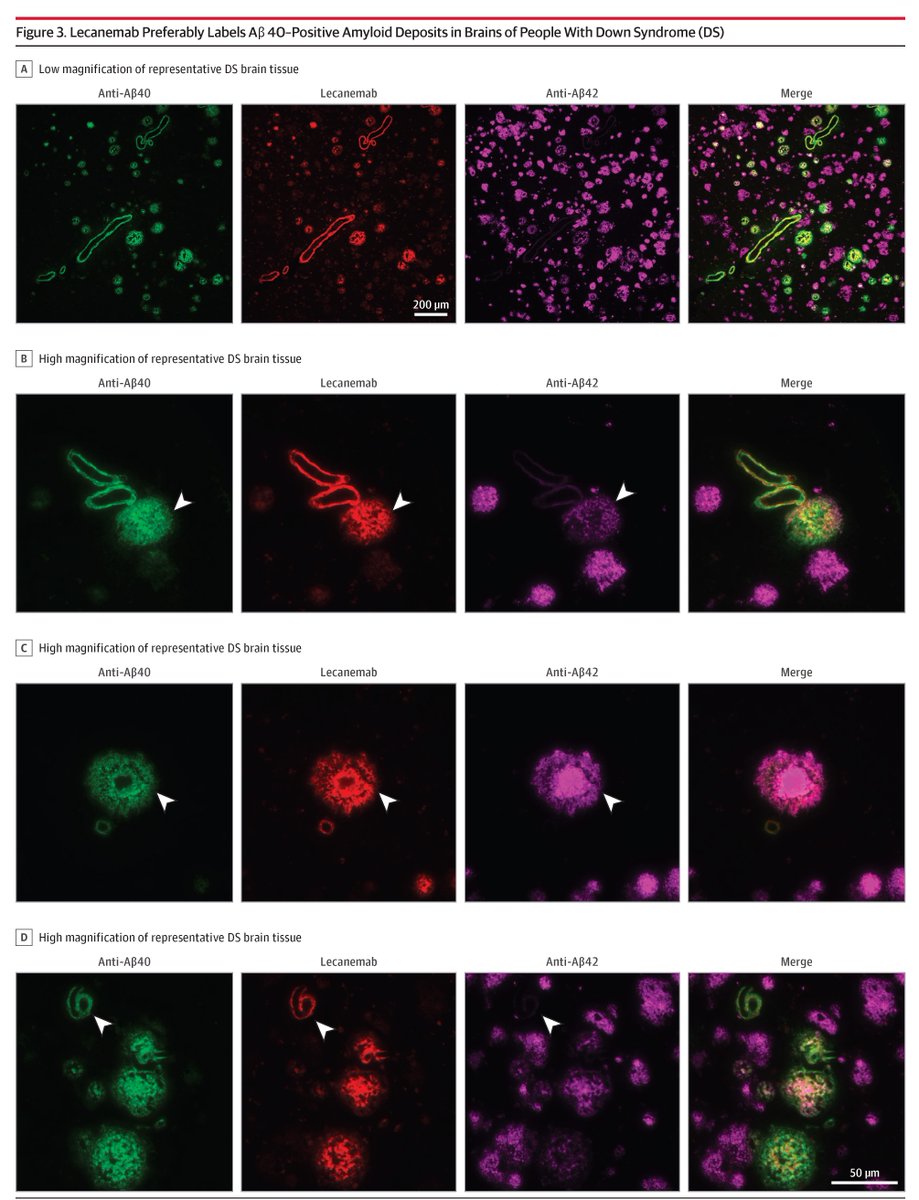 JAMANeuro's tweet photo. Lecanemab, an anti-β-amyloid immunotherapy used in Alzheimer Disease, bound to the amyloid plaques in all 15 Down syndrome cases studied (age 43 and over). Findings underscore the necessity for clinical trials to evaluate both safety &amp; efficacy. https://t.co/5t5R5kdj5Z https://t.co/V4yuvufZ7n