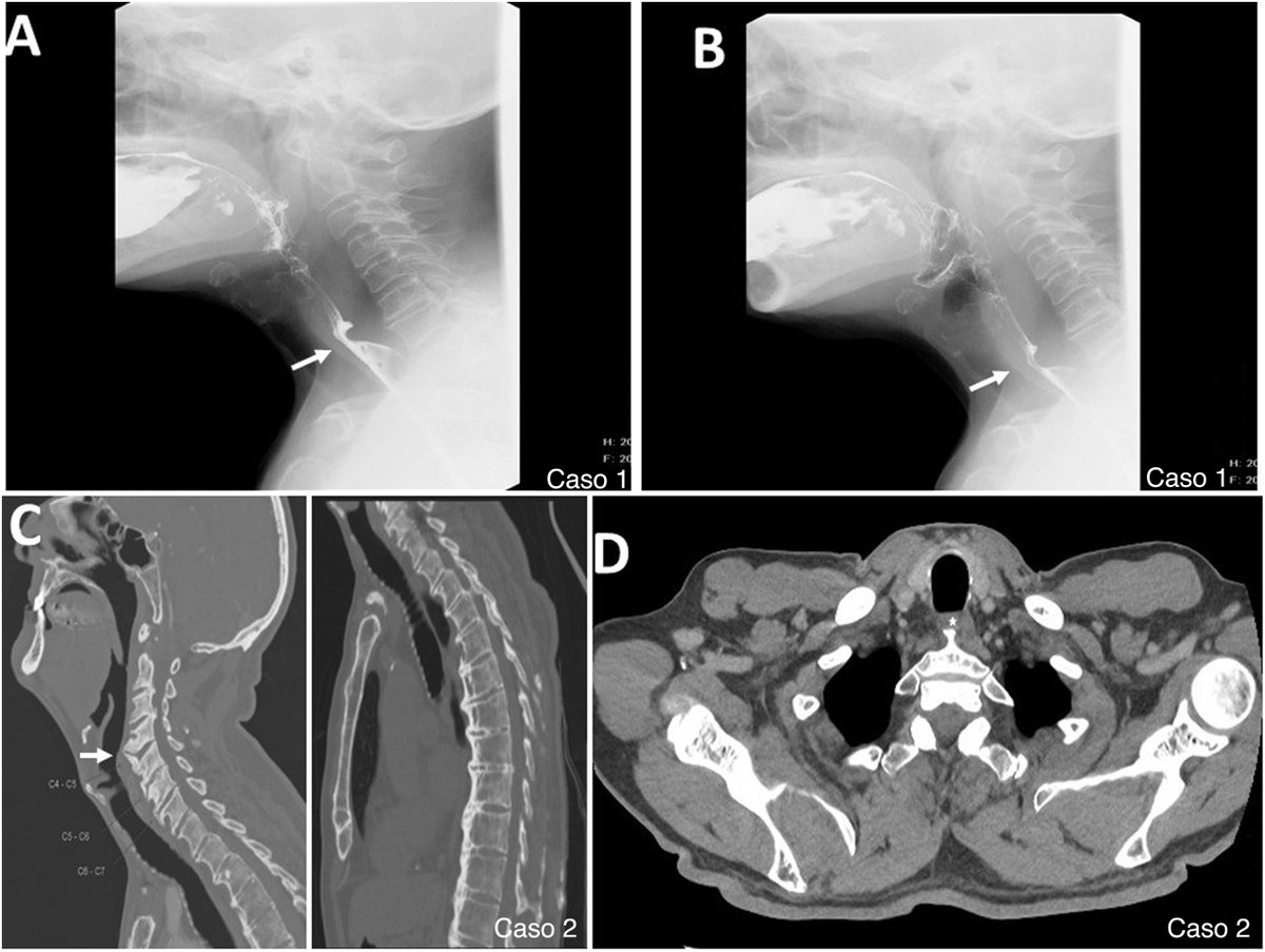 Desafíos en el avance de la sonda de ecocardiografía transesofágica: identificación de causas y soluciones #REC <a href="/LuciaFGasso/">LuciaFernandezG</a> <a href="/reginadalmau/">Regina Dalmau</a> <a href="/cayevalbuena/">Silvia Valbuena</a> <a href="/ElenaRefoyo/">Elena Refoyo</a>  revespcardiol.org/es-desafios-en…