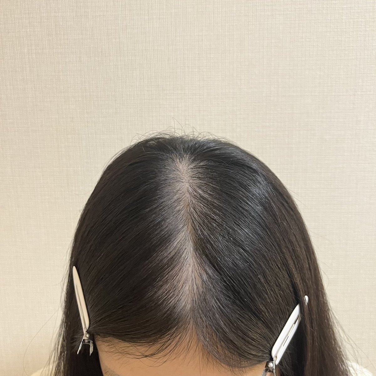 ppppp_8416's tweet photo. 【術後10ヶ月】①術前②術後6ヶ月③8-9ヶ月④10ヶ月 ショートにして抜け毛減ったのはいいけど外出時はまだ全然シャドウ手放せない😥😥色々あって内服やめたしこれ以上しっかり埋めるにはやはりアートメイクかな〜目に見える変化が欲しい😭😭 https://t.co/n2ErJiiK0i