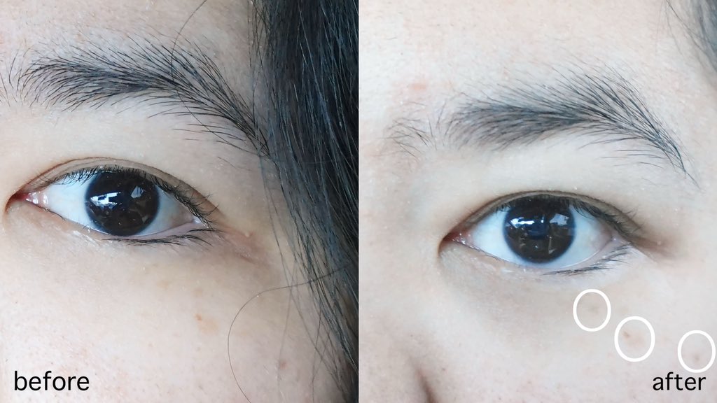 สารภาพนะ เป็นคนใช้กันแดดน้อยมากๆ แบบกว่าจะมาเริ่มใช้ก็สายไปละจ้า จุดด่างดำขึ้นแล้ว🥺ทุกวันนี้เลยหาอะไรใช้ให้มันจางลงอะ ซึ่ง เซรั่ม ของ ลอรีอัล มันโอเคนะ จากที่ลองใช้คู่กันมาทั้งเซรั่มและครีม แต่ย้ำว่าควรใช้ต่อเนื่องนะจะได้เห็นผล แต่ต้องทำใจ มันไม่น่าหาย 100% หรอก แต่จางลงก็ดีใจแล้วว ละที่สำคัญหน้าดูไบร์ทขึ้นแบบเห็นขัดหลังจากใช้ #รีวิวสกินแคร์ #GlycolicBrightMelasyl #LOrealParisTH