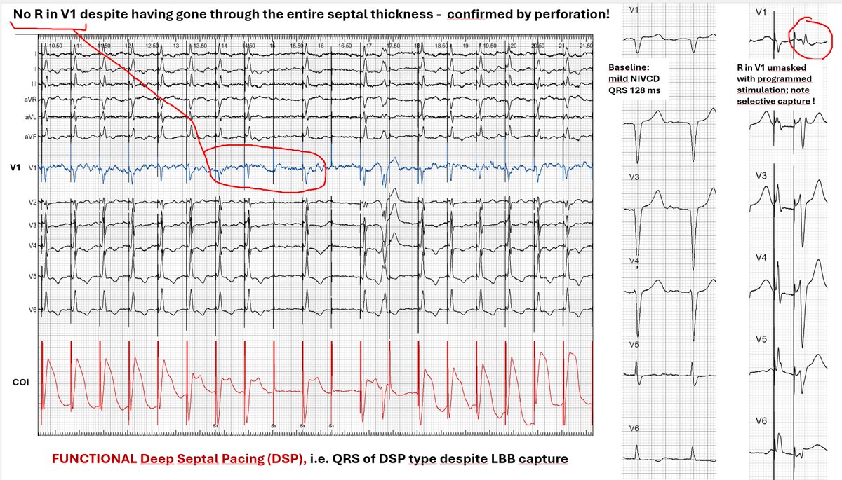 Marek Jastrzębski (@marek_jastrz_ep) on Twitter photo Functional Deep Septal Pacing -explained. The term coined to explain CSPOT results. No terminal V1 r despite perforation, yet selective capture @ programmed stimulation confirms LBB capture. Cause: dysfunctional LV conduction system in IVCD cases. #dontdisthehis #epeeps <a href="/Hisdoc1/">Pugal Vijayaraman</a> Functional Deep Septal Pacing -explained. The term coined to explain CSPOT results. No terminal V1 r despite perforation, yet selective capture @ programmed stimulation confirms LBB capture. Cause: dysfunctional LV conduction system in IVCD cases. #dontdisthehis #epeeps <a href="/Hisdoc1/">Pugal Vijayaraman</a>