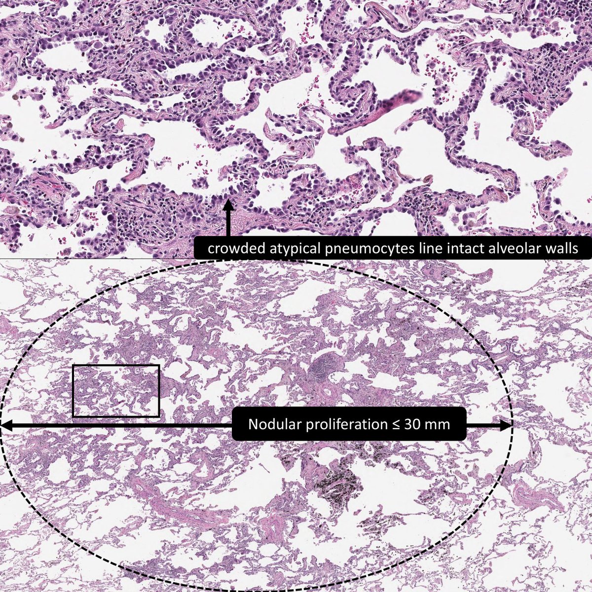 DrCycloPath's tweet photo. 2 of 3) ✅Adenocarcinoma in situ shows a purely lepidic pattern and is no more than 30mm in size
🔬https://t.co/9IVXBgljXQ
#PulmPath #PathTwitter #pathology https://t.co/nxtmLECWGO