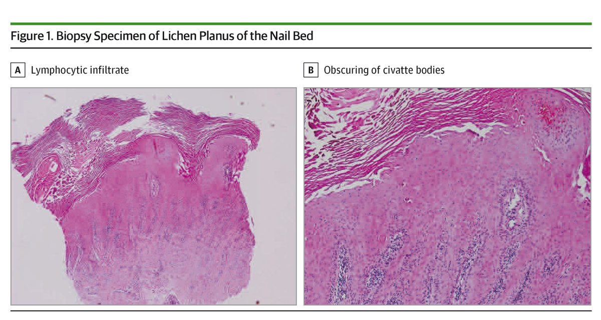 Low-dose naltrexone shows promise in treating nail lichen planus with notable improvement and no side effects. ja.ma/3YI1ZNW