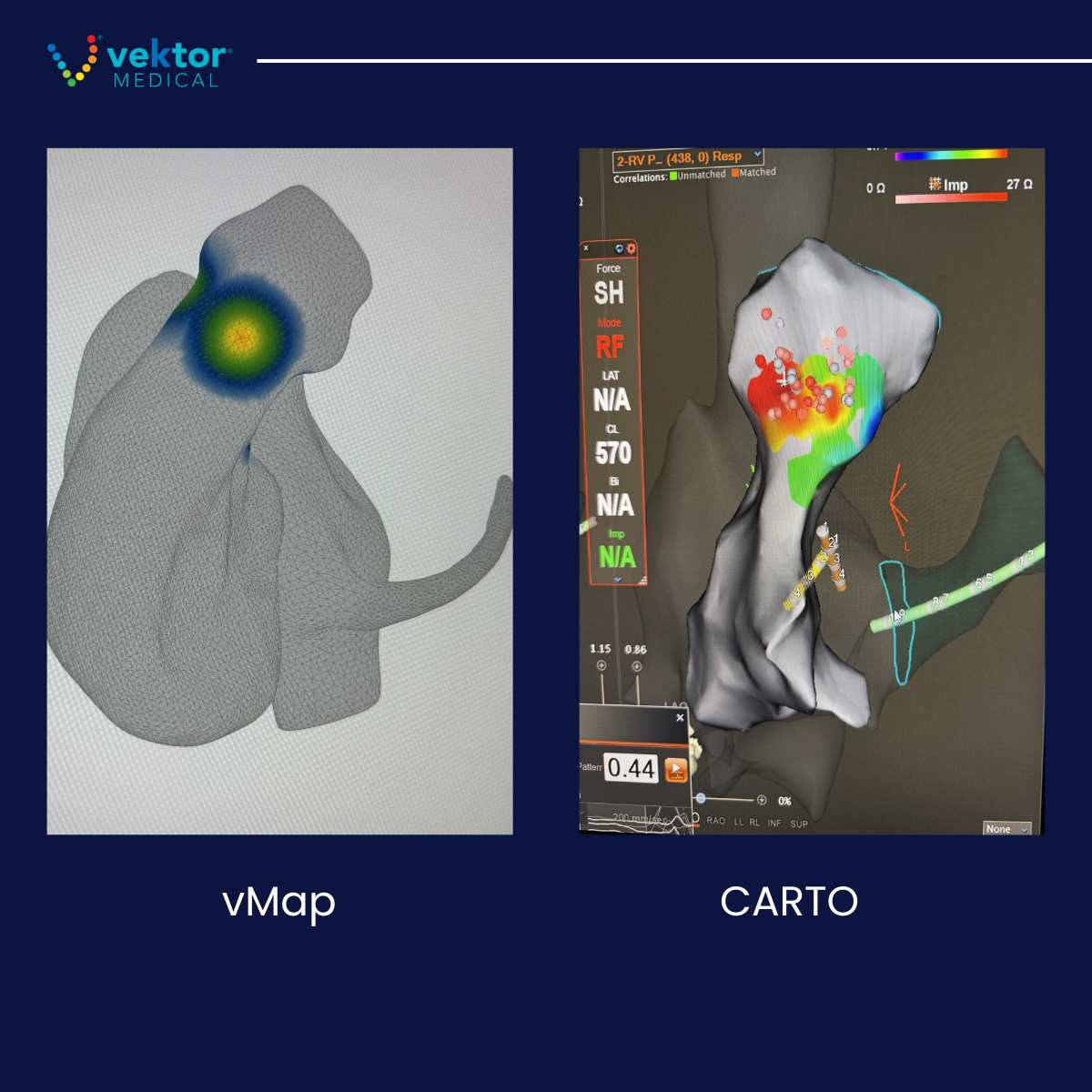 VektorMedical's tweet image. 🫀Clinical Case with Dr. John Miller, IU Health:  Female in her 30s presents for ablation of frequent PVCs. Patient had two prior procedures to ablate PVCs at OSH with no change.

Details ⬇️

#epeeps #cardiology #EPLab #patientcare