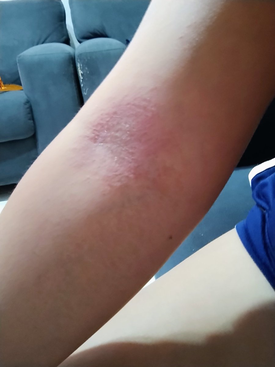 Pauugrc's tweet photo. Haganle caso a su cuerpo a la primera, no hasta que se tengan que llenar de ronchas por el estrés https://t.co/4Hfmy0FuqA
