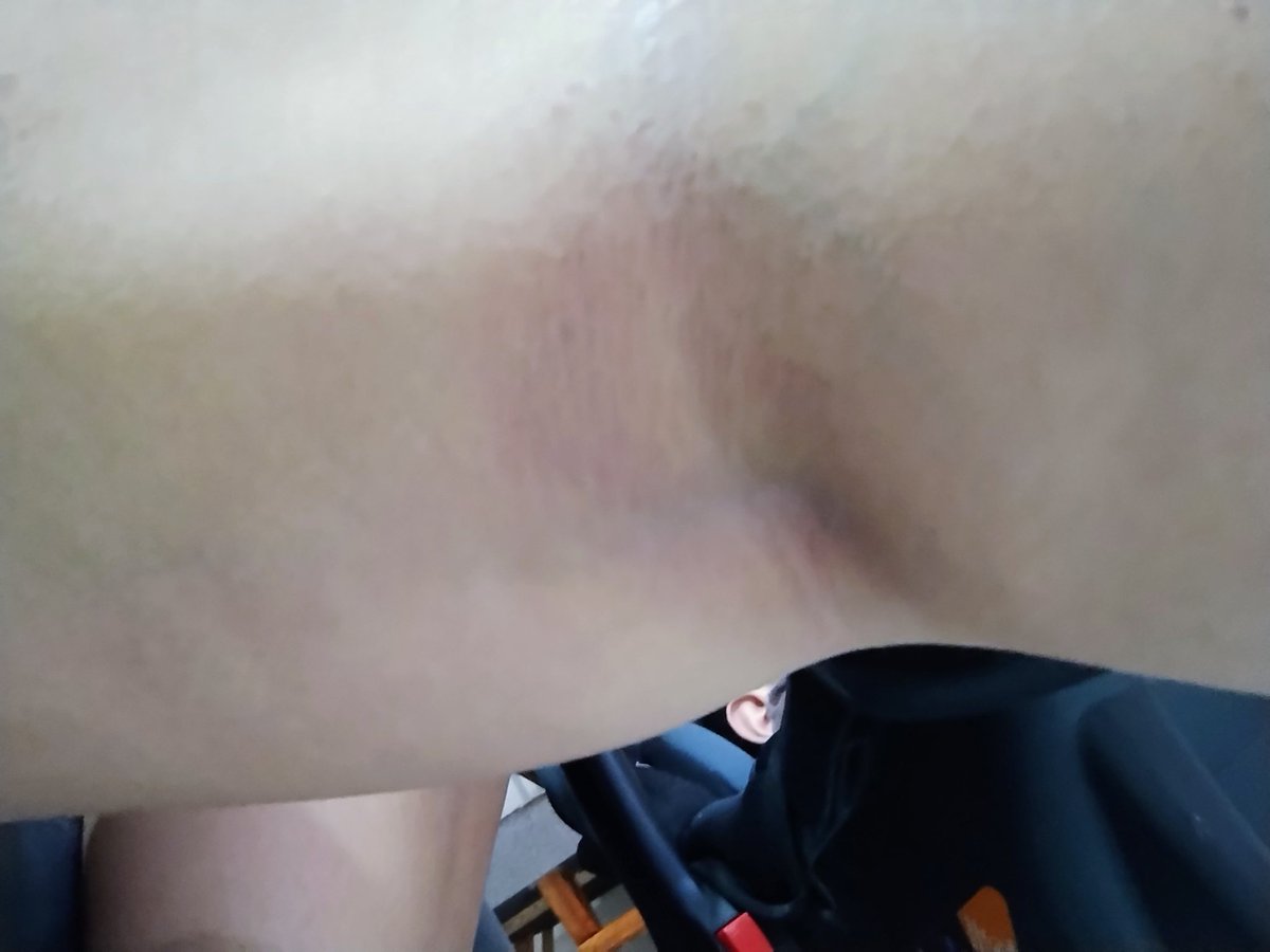 Pauugrc's tweet photo. Haganle caso a su cuerpo a la primera, no hasta que se tengan que llenar de ronchas por el estrés https://t.co/4Hfmy0FuqA