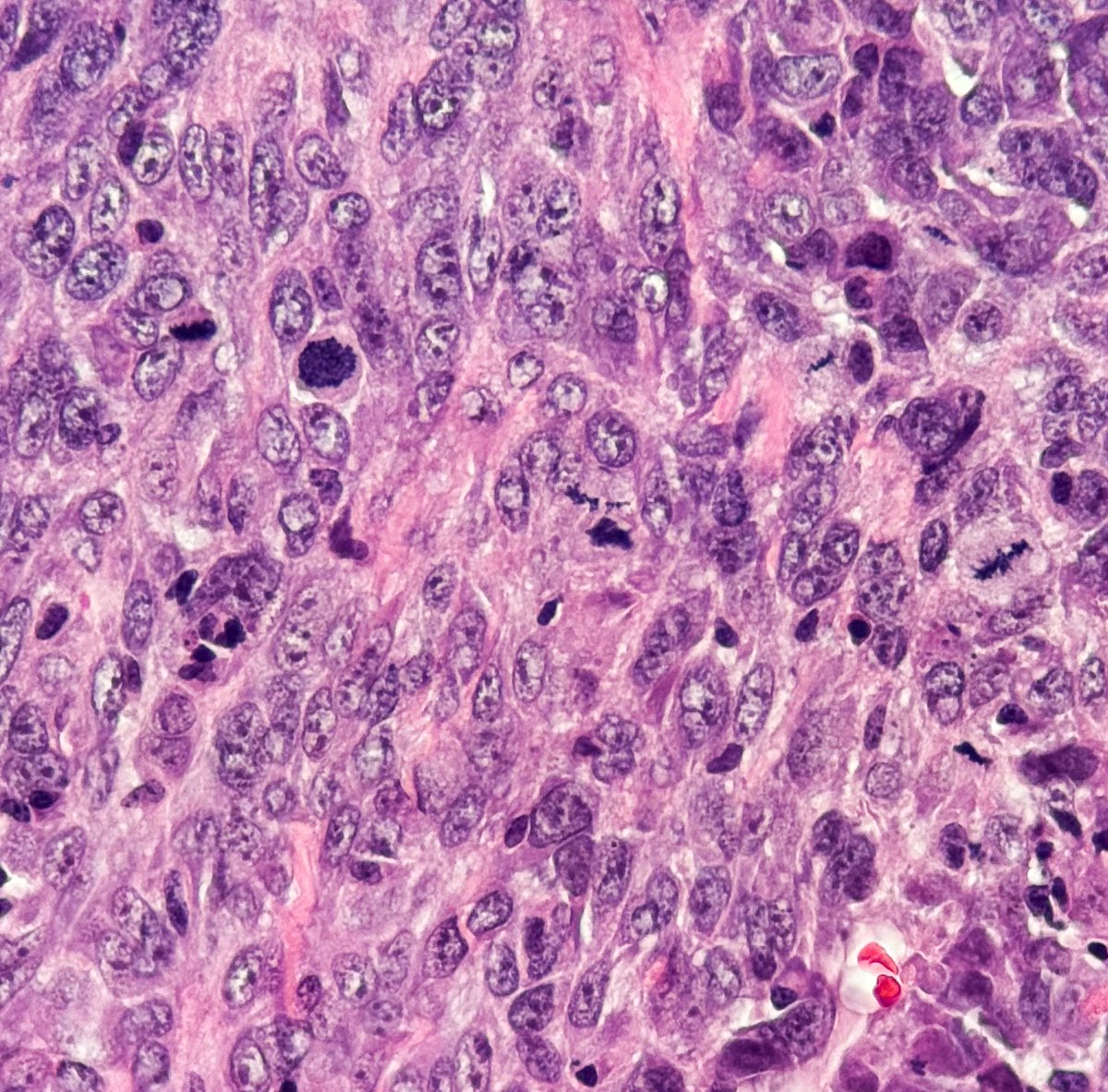 PenafortPaulo's tweet photo. A spine-chilling case for Halloween 🎃 
#oralpathology #oralpath #pathology https://t.co/KxJYBTsT6K