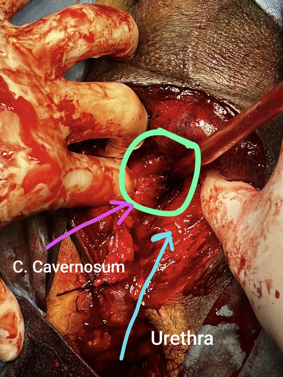 #penile fracture After a #MVA. Corpus cavernosum Is lesioned by the ischiopubic ramus. 
T&amp;T:
1- Perineal incisione
2- Identify #urethra
3- Remove #hematoma 🆎
4- Slightly rotate CC (the lesion at the surface with the bone) and fix It.
5- Insert a drain
6- Enjoy surgery!!!🔪😎