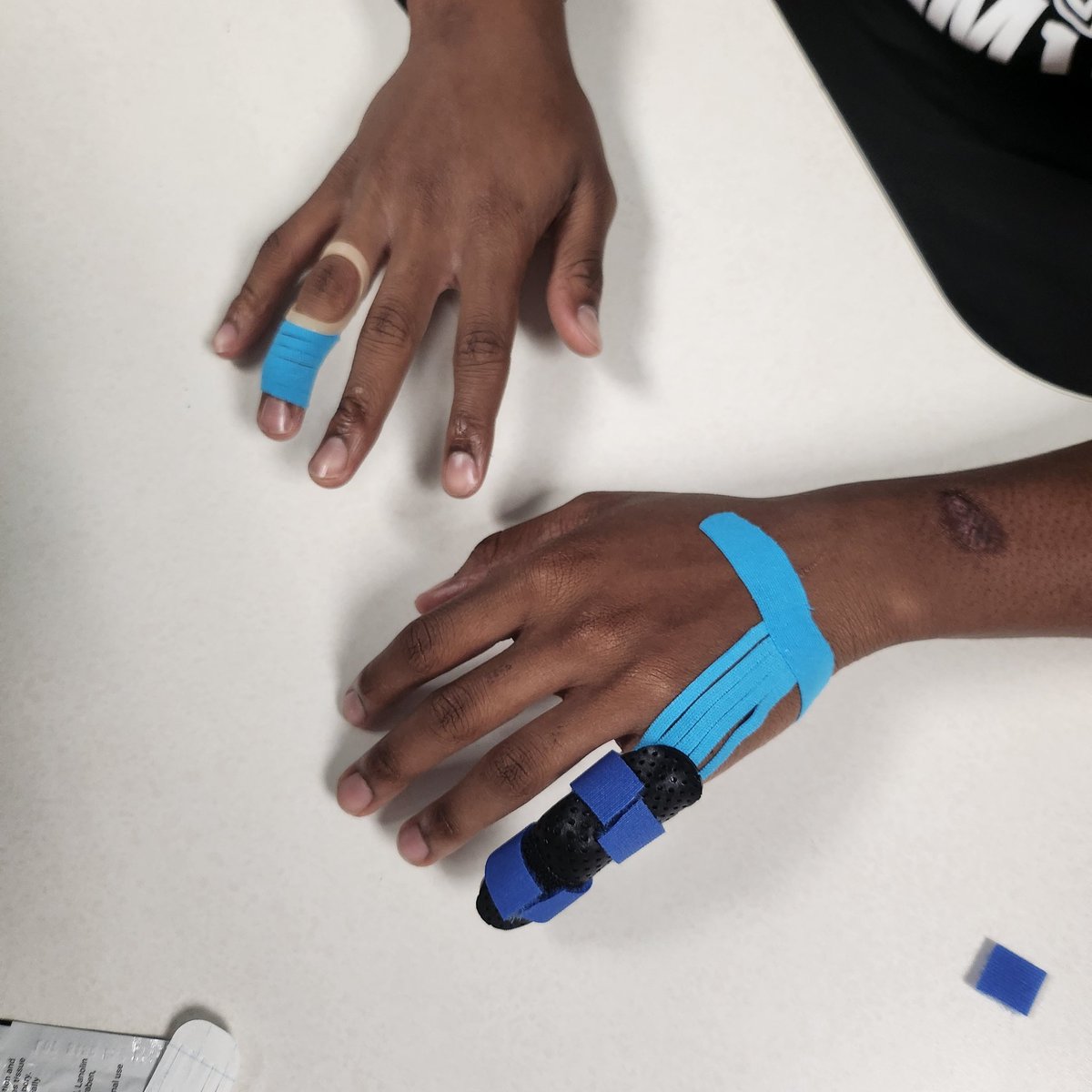 So apparently, Chad's first broken finger didn't heal properly. Now he's doing Occupational Therapy for both hands 🙄🫣🤑
#Is it track season yet 
#This has gotten expensive 
#Football is dangerous
<a href="/chad_superman/">Chad Nelson ‘27</a>