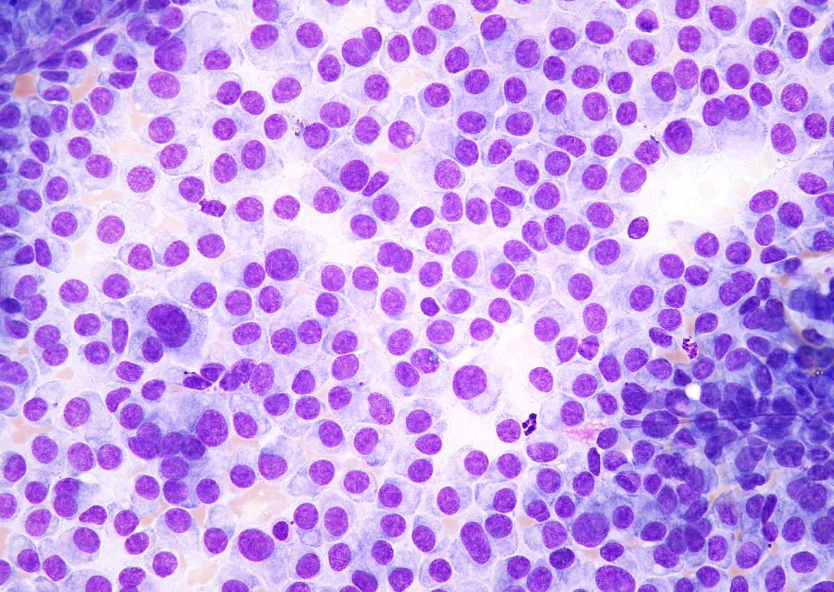 “Cholangiocarcinoma” on a liver FNA, simulating a neuroendocrine tumor (such as metastatic PanNET) due to a remarkable single cell plasmacytoid appearance.