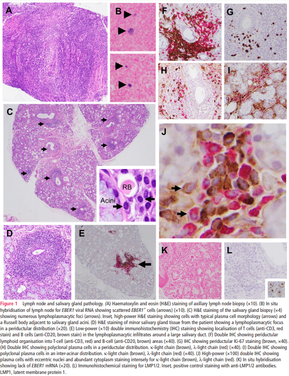 eular_ARD's tweet image. 🕵️  Unraveling the role of primary #EBV infection in developing #SjogrenDisease 

📅 Anti-Ro52 and anti-Ro60 present 7 days after infection underwent IgM➡️IgG switching
📈 7 months later, Abs EBNA1 &amp;amp; Abs U1RNP appeared concomitantly▶️ #molecularmimicry

🔗 bit.ly/48J7zDr