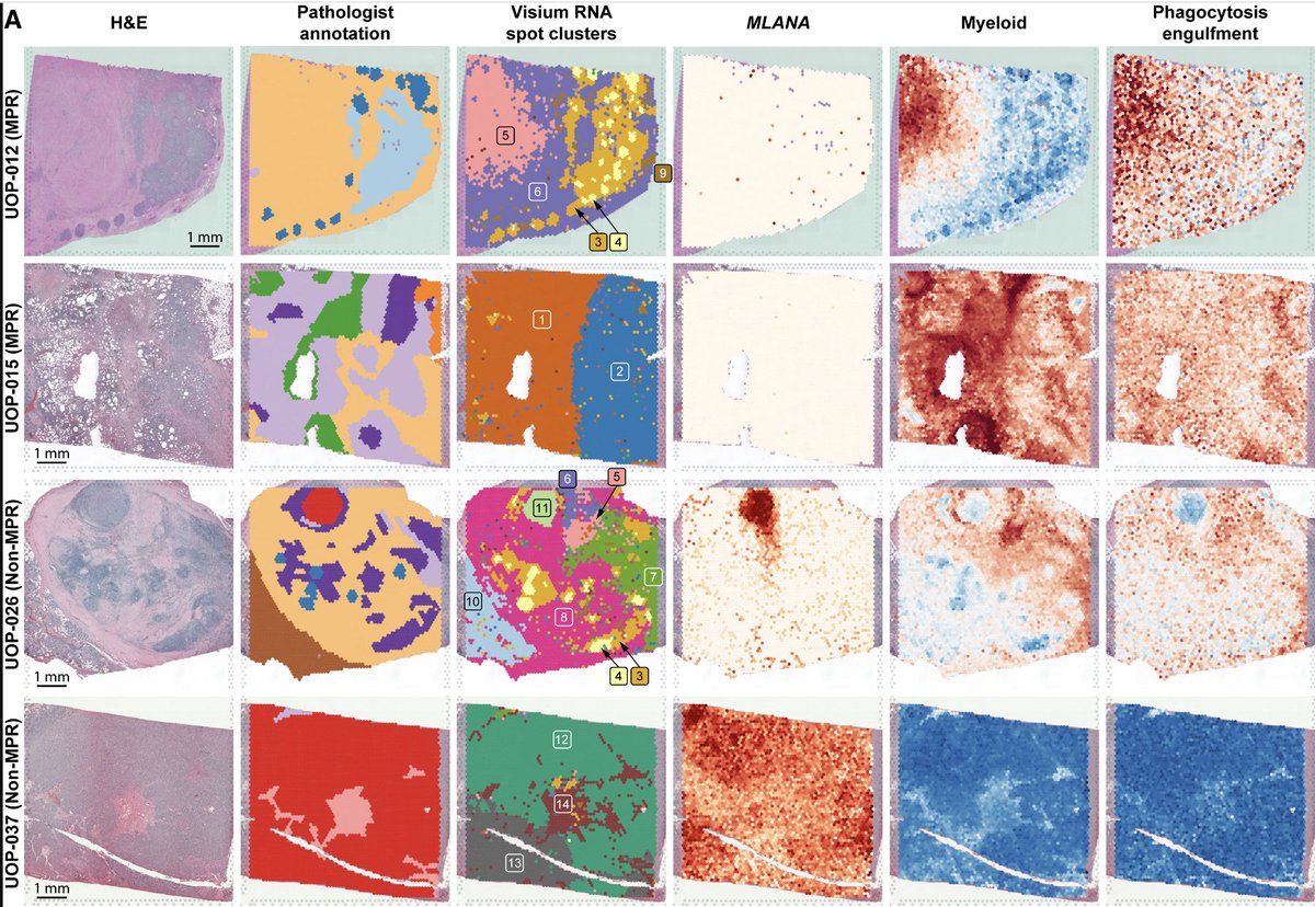 Diwakar Davar, M.D. (@diwakardavar) on Twitter photo (3/5) Tumor eval using NanoString GeoMx and ST (<a href="/10xGenomics/">10x Genomics</a>) implicated intratumoral pDCs and myeloid cells in vidu anti-tumor effects. Significant peripheral immune activation by flow. LCMS #proteomics by #CPTAC colleagues <a href="/fredhutch/">Fred Hutch Cancer Center</a> identified a peripheral PD signature. (3/5) Tumor eval using NanoString GeoMx and ST (<a href="/10xGenomics/">10x Genomics</a>) implicated intratumoral pDCs and myeloid cells in vidu anti-tumor effects. Significant peripheral immune activation by flow. LCMS #proteomics by #CPTAC colleagues <a href="/fredhutch/">Fred Hutch Cancer Center</a> identified a peripheral PD signature.