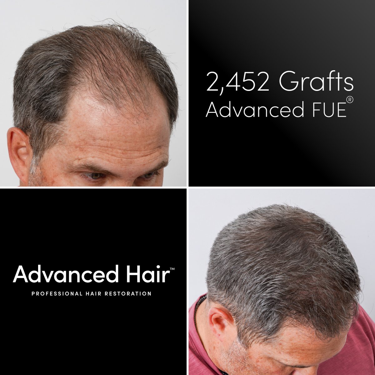 GoAdvancedHair's tweet photo. 🦾Witness the power of transformation with:
Advanced Hair Restoration's 🥼 Advanced FUE® hair transplant!  

These before-and-after photos capture a journey from thinning hair to a fuller, more youthful look. Our Advanced FUE® technique offers precision and natural results without linear scarring, giving you the freedom to style with confidence. Don’t just dream of renewed hair—make it a reality with Advanced Hair Restoration, LOCATED ALL AROUND THE USA 🇺🇸

💥 Ready to take the first step? Book your FREE consultation now! Link in bio or visit https://t.co/Cyf6dFCk9F 

#HairRestoration #AdvancedFUE #HairTransplant #HairTransformation #BeforeAndAfter #FullerHair #ConfidenceBoost #HairGoals #FUE