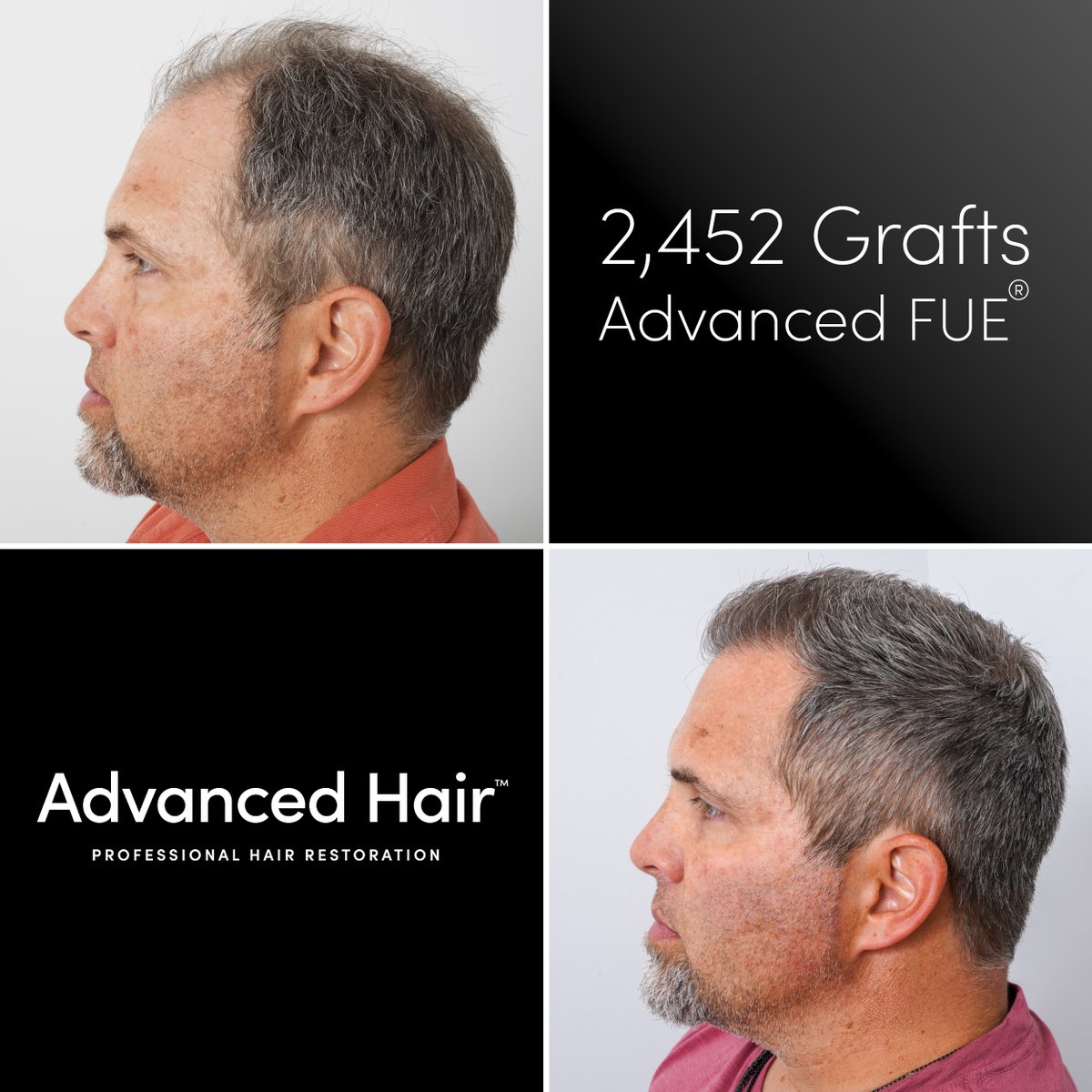 GoAdvancedHair's tweet photo. 🦾Witness the power of transformation with:
Advanced Hair Restoration's 🥼 Advanced FUE® hair transplant!  

These before-and-after photos capture a journey from thinning hair to a fuller, more youthful look. Our Advanced FUE® technique offers precision and natural results without linear scarring, giving you the freedom to style with confidence. Don’t just dream of renewed hair—make it a reality with Advanced Hair Restoration, LOCATED ALL AROUND THE USA 🇺🇸

💥 Ready to take the first step? Book your FREE consultation now! Link in bio or visit https://t.co/Cyf6dFCk9F 

#HairRestoration #AdvancedFUE #HairTransplant #HairTransformation #BeforeAndAfter #FullerHair #ConfidenceBoost #HairGoals #FUE