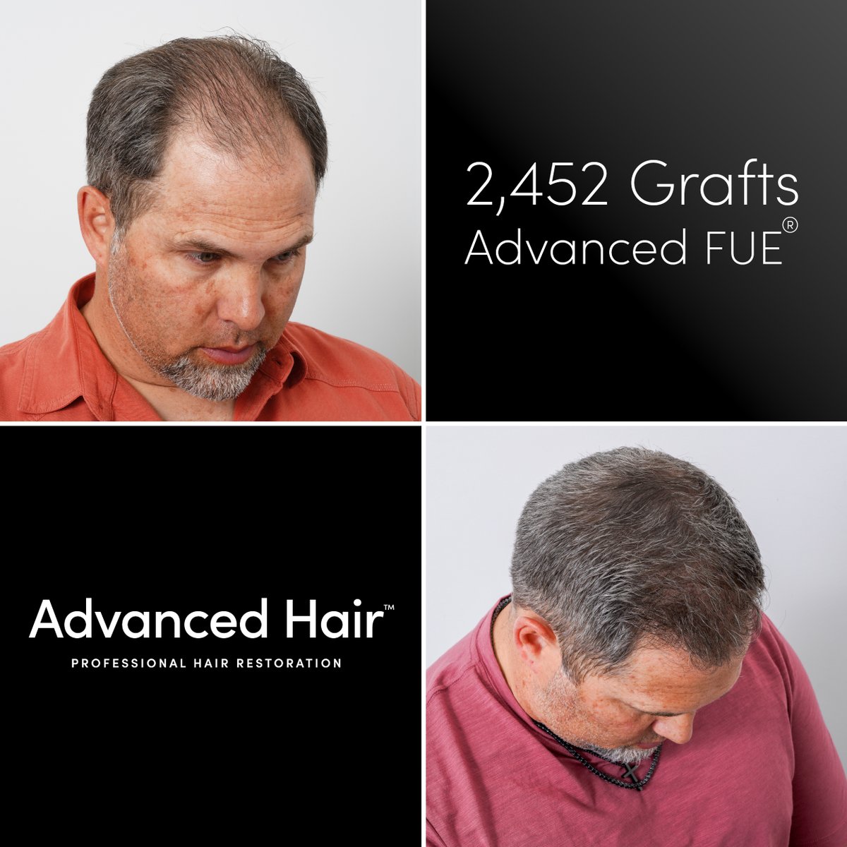 GoAdvancedHair's tweet photo. 🦾Witness the power of transformation with:
Advanced Hair Restoration's 🥼 Advanced FUE® hair transplant!  

These before-and-after photos capture a journey from thinning hair to a fuller, more youthful look. Our Advanced FUE® technique offers precision and natural results without linear scarring, giving you the freedom to style with confidence. Don’t just dream of renewed hair—make it a reality with Advanced Hair Restoration, LOCATED ALL AROUND THE USA 🇺🇸

💥 Ready to take the first step? Book your FREE consultation now! Link in bio or visit https://t.co/Cyf6dFCk9F 

#HairRestoration #AdvancedFUE #HairTransplant #HairTransformation #BeforeAndAfter #FullerHair #ConfidenceBoost #HairGoals #FUE