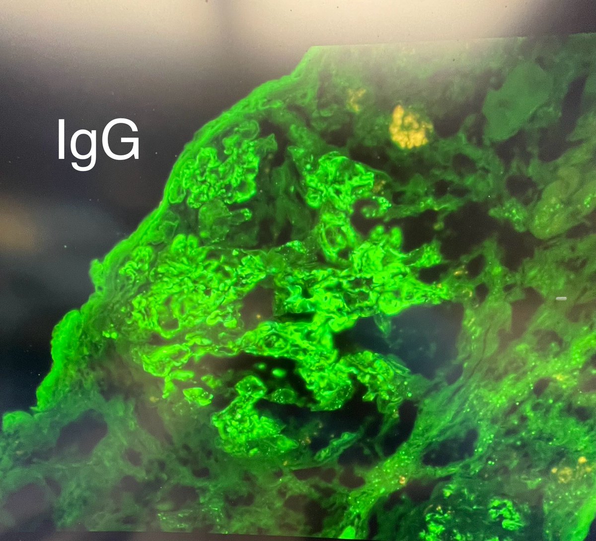 SethiRenalPath's tweet photo. Immunotactoid glomerulopathy (ITG): 45-yr old with hematuria, proteinuria, Non-Hodgkin lymphoma

LM: MPGN pattern

IF: IgG kappa
Subtype: IgG1

EM: microtubular deposits along capillary wall

IgG deposits are usually monoclonal (monoclonal ITG) &amp; associated with a lymphoma. 1/2 https://t.co/uMU9aUE65k