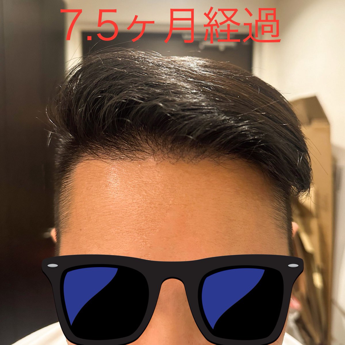 CEO_bodymaker's tweet photo. 【植毛から9ヶ月】
事業が忙し過ぎて正直ハゲそう…🥲という気持ちですが、ありがたいことに移植毛は順調に成長しています。笑

個人的には高リスクと考えていないのですが、ミノタブは心臓肥大になることがあるらしいので今度心臓検査に行こうと思いました。

@pagepagetan
@pasuoat
🙏✨ https://t.co/KAzQo96FAS