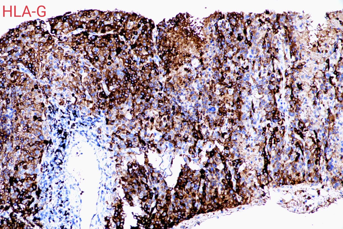 dnarna111's tweet photo. Metastatic ETT of the lung is extremely rare in postmenopausal women. But we met one. https://t.co/DVdFc3PFrk