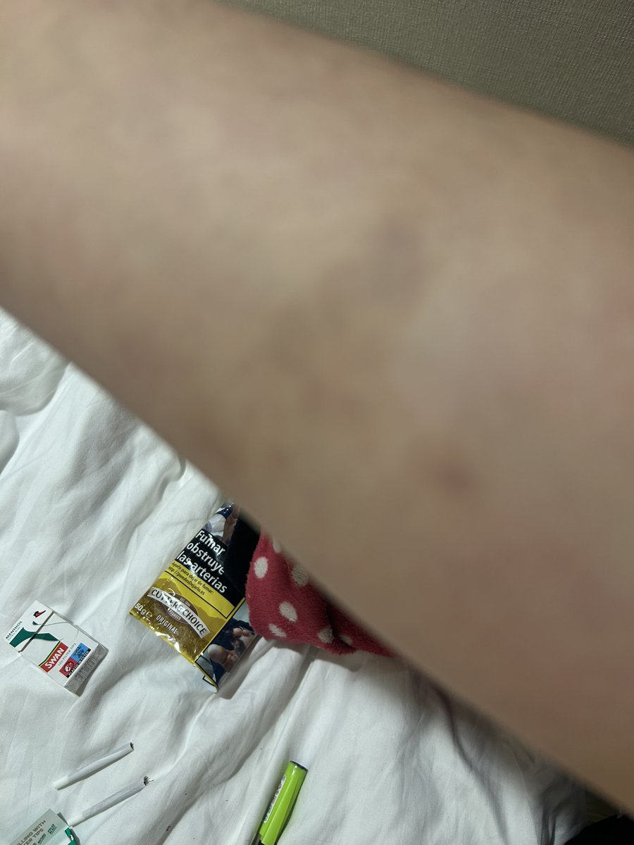 Yvette_Fans's tweet photo. Look at this! It wasn’t there before the stage show started it really hurts, I only noticed it when I came back to the hotel, looks likes a child’s finger prints! What do you think? @Yfielding @realkarlbeattie @RadioGlen @StuartTorevell1 

#MostHauntedStageShow 
#MostHauntedLive https://t.co/Oc33FSfGOy