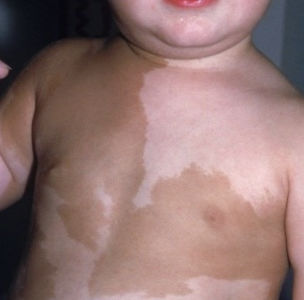 USMLEStepStudy's tweet photo. McCune–Albright syndrome: somatic mutation GNAS gene (20q13.32)  --> stimulation of endocrine function --> abnormal tissue growth &amp; hormonal dysregulation; s/s: café au lait spots, macroorchidism, polyostotic fibrous dysplasia, precocious puberty; Rx: oral phosphate, calcitriol https://t.co/E0miSKwg0E