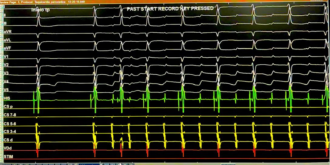 6 yof pt w/AVNRT.
Patient under GA.
Junctional rhythm most of the time.
Spontaneous AVNRT onset with 2:1 conduction.
There is no PACs to beget the reentrant circuit in the AVN.
I find this is a complete dissociation of SP/FP to this kind of onset.
I’ve  never seen this before.