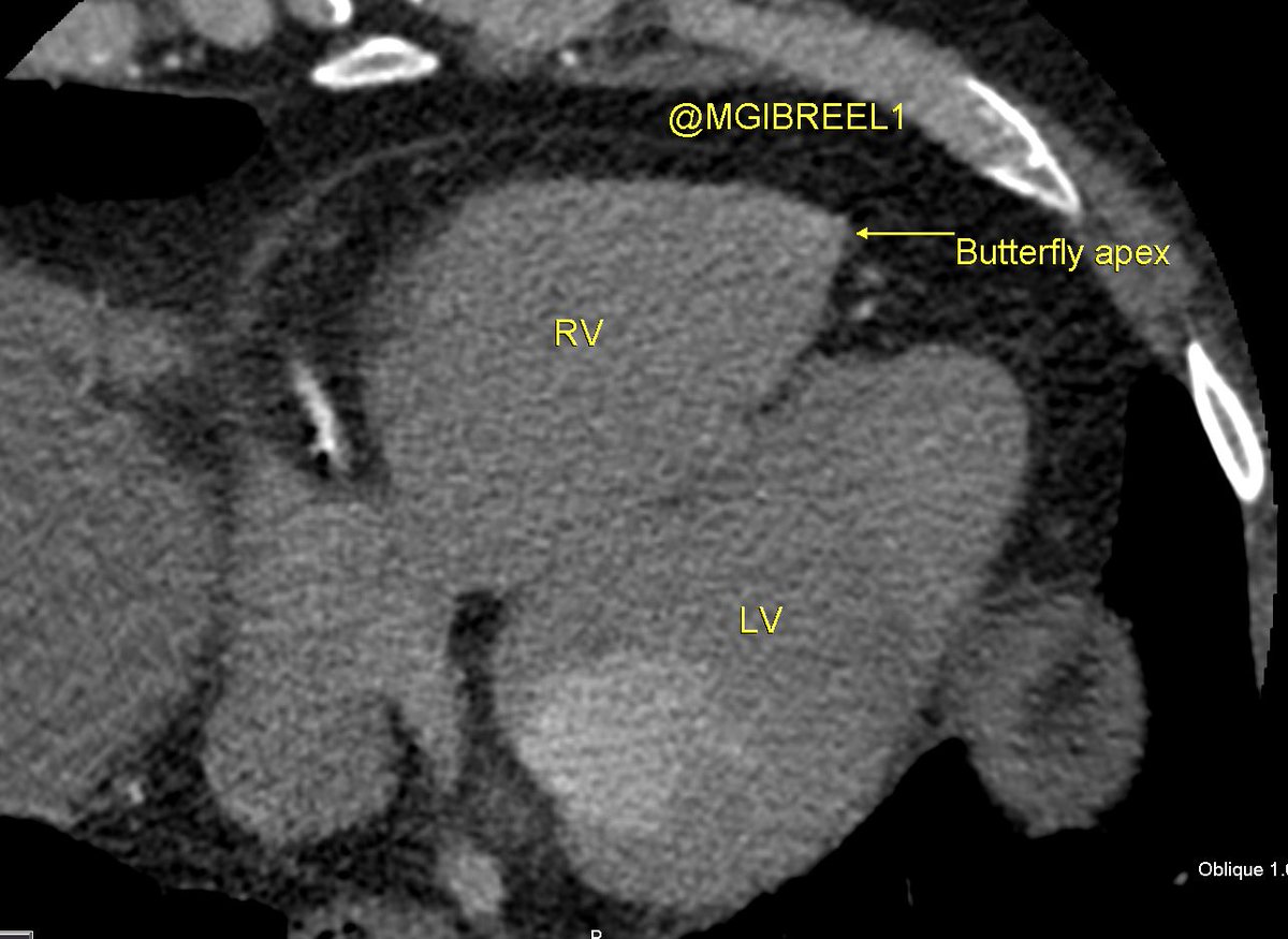 Butterfly RV apex , normal variant
