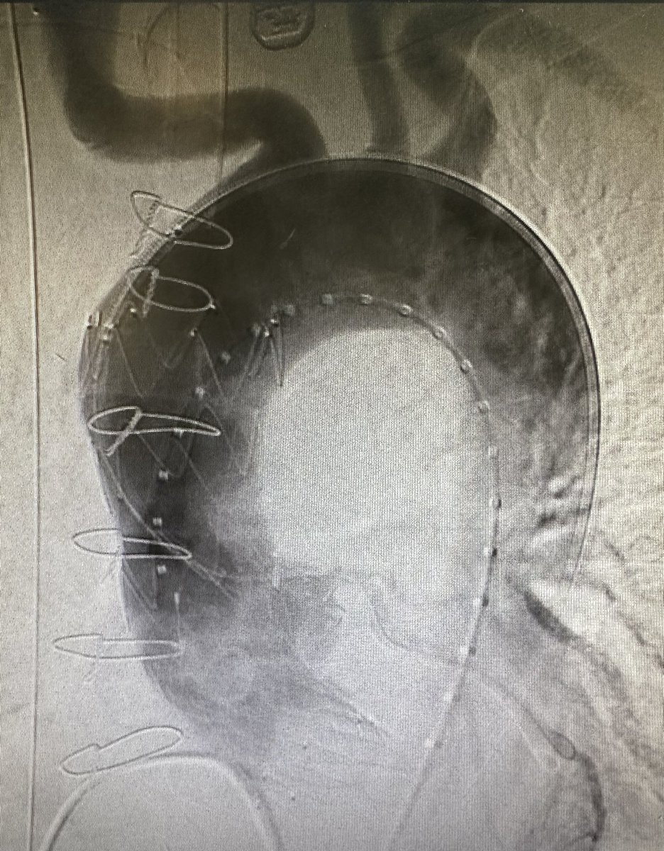 woostermd (@woostermd) on Twitter photo The future is here. #aortaed thrilled to be able to offer advanced endovascular solutions to patients without other options. #endobentall made feasible thanks to collaborative care with <a href="/DrZeigler1/">Aorta guy</a> <a href="/MUSCVascular/">MUSC Vascular Surgery</a> <a href="/MUSCSurgery/">MUSC Department of Surgery</a> <a href="/MUSCCardFellows/">MUSC Cardiology Fellowship Programs</a>
**patent RIMA-RCA bypass not shown** The future is here. #aortaed thrilled to be able to offer advanced endovascular solutions to patients without other options. #endobentall made feasible thanks to collaborative care with <a href="/DrZeigler1/">Aorta guy</a> <a href="/MUSCVascular/">MUSC Vascular Surgery</a> <a href="/MUSCSurgery/">MUSC Department of Surgery</a> <a href="/MUSCCardFellows/">MUSC Cardiology Fellowship Programs</a>
**patent RIMA-RCA bypass not shown**