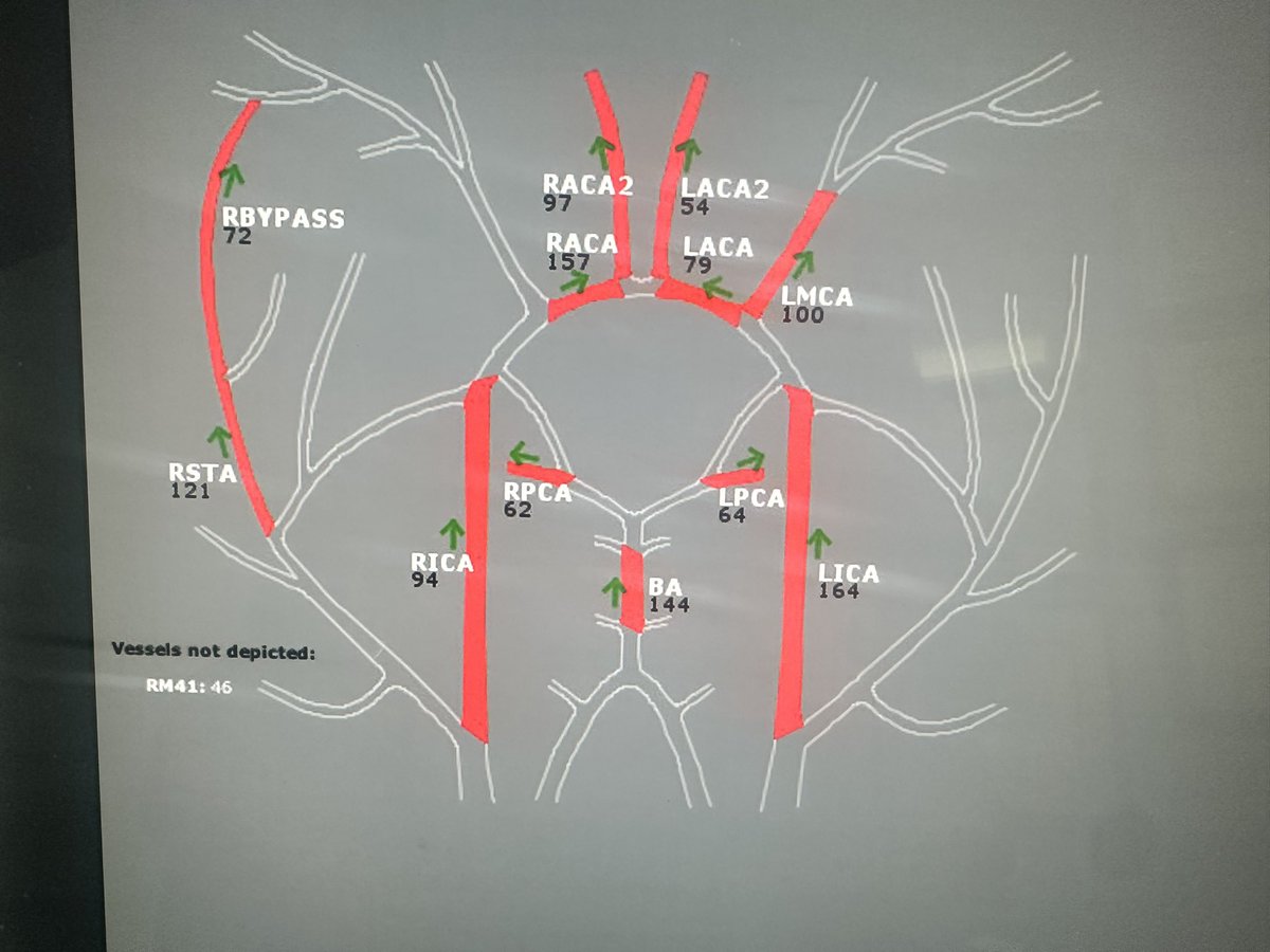 Dr Amir R. Dehdashti (@amirdehdashti) on Twitter photo One of our project is to define pattern of indirect revascularization along with direct bypass in #Moyamoya My surgical strategy is combined direct and indirect Look at routine 6 months angio & Nova MR to identify key indirect anastomoses despite robust direct bypass <a href="/cvsection/">CV Section</a> One of our project is to define pattern of indirect revascularization along with direct bypass in #Moyamoya My surgical strategy is combined direct and indirect Look at routine 6 months angio & Nova MR to identify key indirect anastomoses despite robust direct bypass <a href="/cvsection/">CV Section</a>