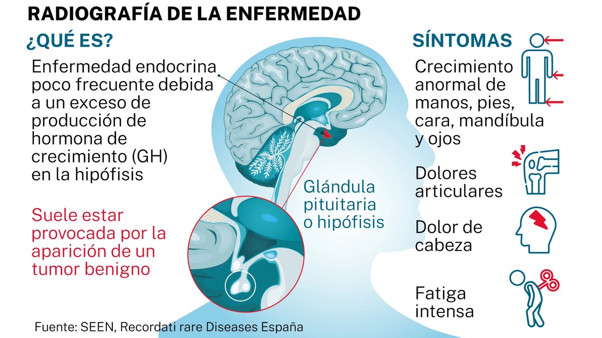 TuendocrinoSEEN's tweet photo. #DíaMundialdelaAcromegalia 👉 #ACROFAST: un ejemplo de colaboración en red de #enfermedadesraras 

Estudio coordinado por el Dr. Manel Puig y con la participación de investigadores del Hosp. German Trias y del área de @NeuroSEEN de @SociedadSEEN. 

 ➕ℹ https://t.co/kiI8Pqyhcv https://t.co/cM0wfkpnn5