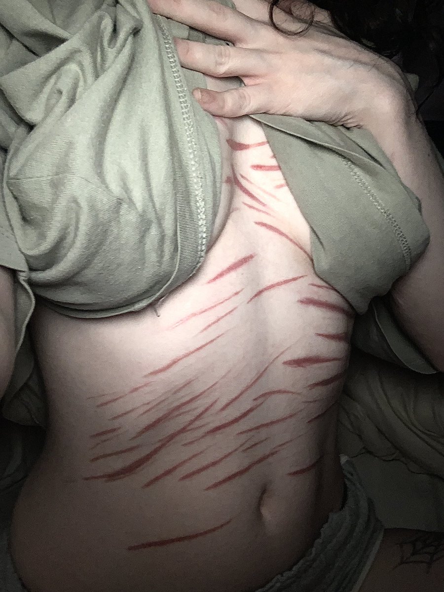 shcaramousse's tweet photo. scars ^^ https://t.co/cONvfa3ak6