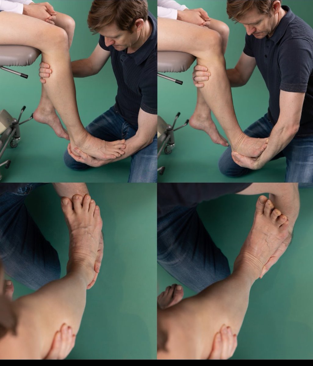 farazzledphysio's tweet photo. 🔴 Dorsiflexion/External Rotation Test 🔴

✅ Syndesmosis ligament tenderness (92%) and the dorsiflexion-external rotation test (71%) have the highest sensitivity values.

✅ Syndesmosis injury was 4x more likely to be present with a +ve dorsiflexion/external rotation test. https://t.co/Ajp6GiMFLx