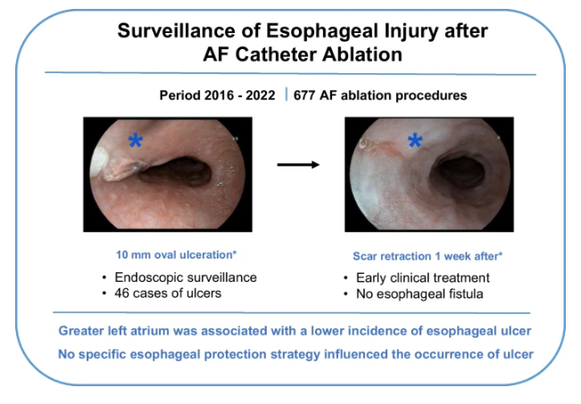 🚨Latest #FreeRead Article in
<a href="/JICE_EP/">JICE</a>

Surveillance of Esophageal Injury after Atrial Fibrillation Catheter Ablation

📖🧐rdcu.be/dYRt9

by Alberto Pereira Ferraz, <a href="/crpisani/">Cristiano Pisani</a>, Esteban Wisnivesky Rocca Rivarola, Tan Chen Wu, Francisco Carlos da Costa Darrieux,
