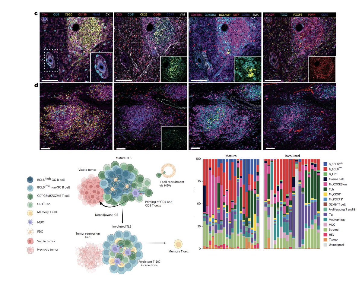 Arndt Vogel (@arndtvogel) on Twitter photo Immunotherapy response induces divergent tertiary lymphoid structures in HCC
<a href="/NatImmunol/">Nature Immunology</a>
doi.org/10.1038/s41590…
👉 intratumoral TLS density⬆️after ICB -> MPR & RFS ⬆️
👉CD20+CXCL13+ LAs surrogate for TLS ?
👉involuted TLS morphology after tumor regression
🥲exciting times for Immunotherapy response induces divergent tertiary lymphoid structures in HCC
<a href="/NatImmunol/">Nature Immunology</a>
doi.org/10.1038/s41590…
👉 intratumoral TLS density⬆️after ICB -> MPR & RFS ⬆️
👉CD20+CXCL13+ LAs surrogate for TLS ?
👉involuted TLS morphology after tumor regression
🥲exciting times for