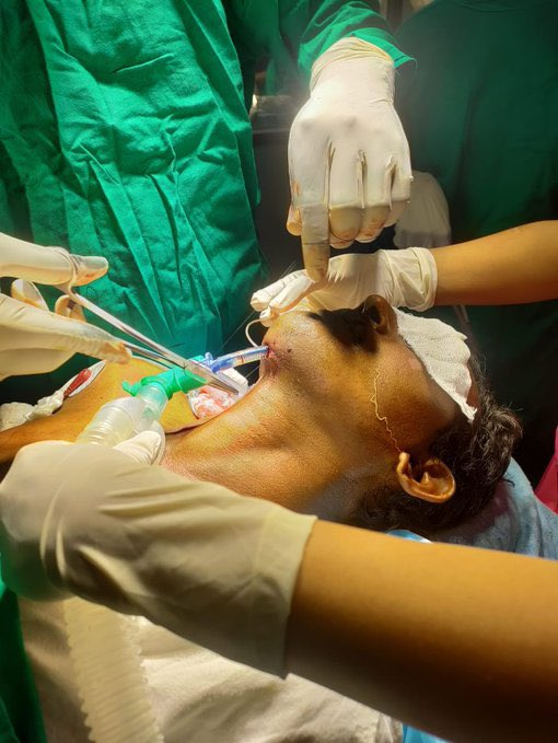 RebMedicina's tweet photo. 📌INTUBACIÓN SUBMENTONIANA

Permite acceder a las cavidades oral y nasal para realizar procedimientos quirúrgicos. 

Es una alternativa segura y efectiva para pacientes con fracturas maxilofaciales complejas, obstrucción nasal o malformaciones cráneo-maxilofaciales
#FOAMed #MedEd https://t.co/LvytXD7Pbl
