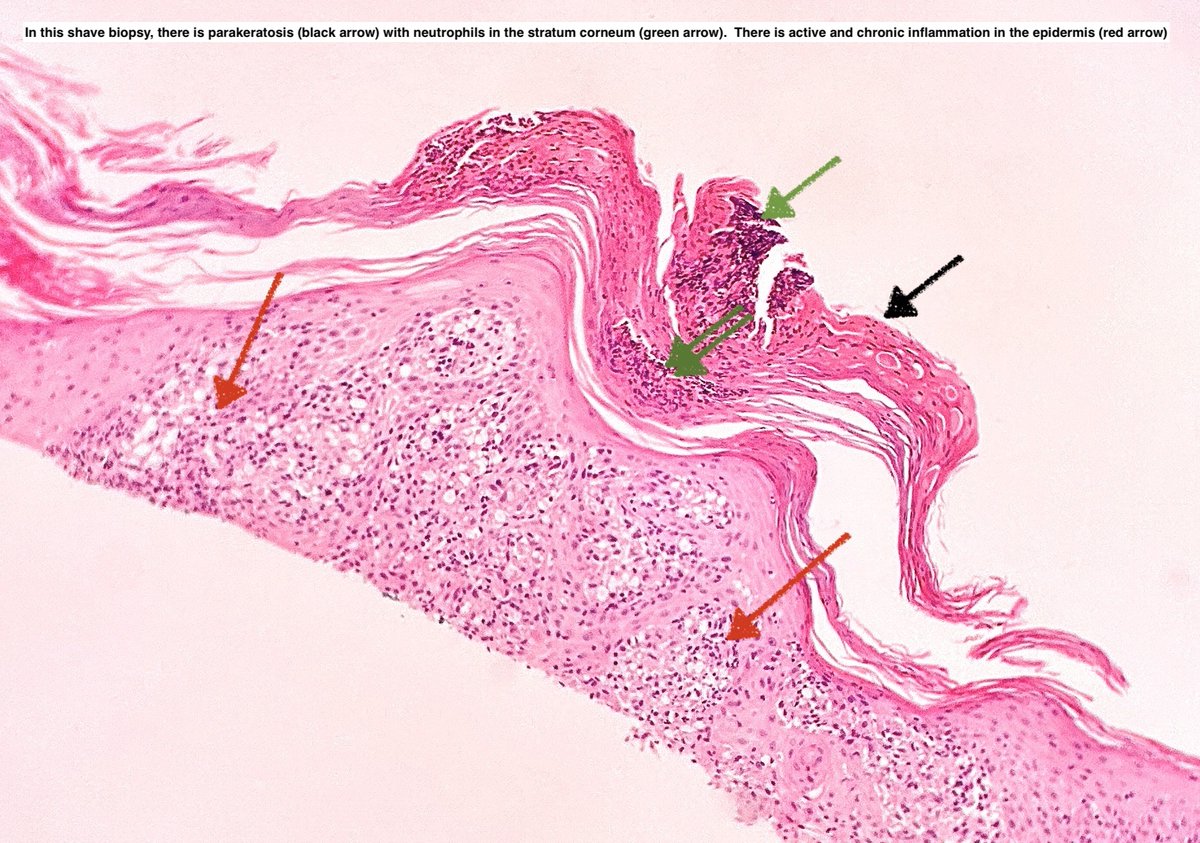 Path4People's tweet photo. A case of Cutaneous Leishmaniasis

Shave biopsy of facial papule ⬇️ 

#pathx #dermx #micro #medx #microtwitter https://t.co/nt42l2FsAn