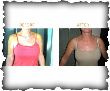 I can think of at least 10 reasons for regularly taking photos of your #vitiligo... thevitpro.com/take-photos-of…