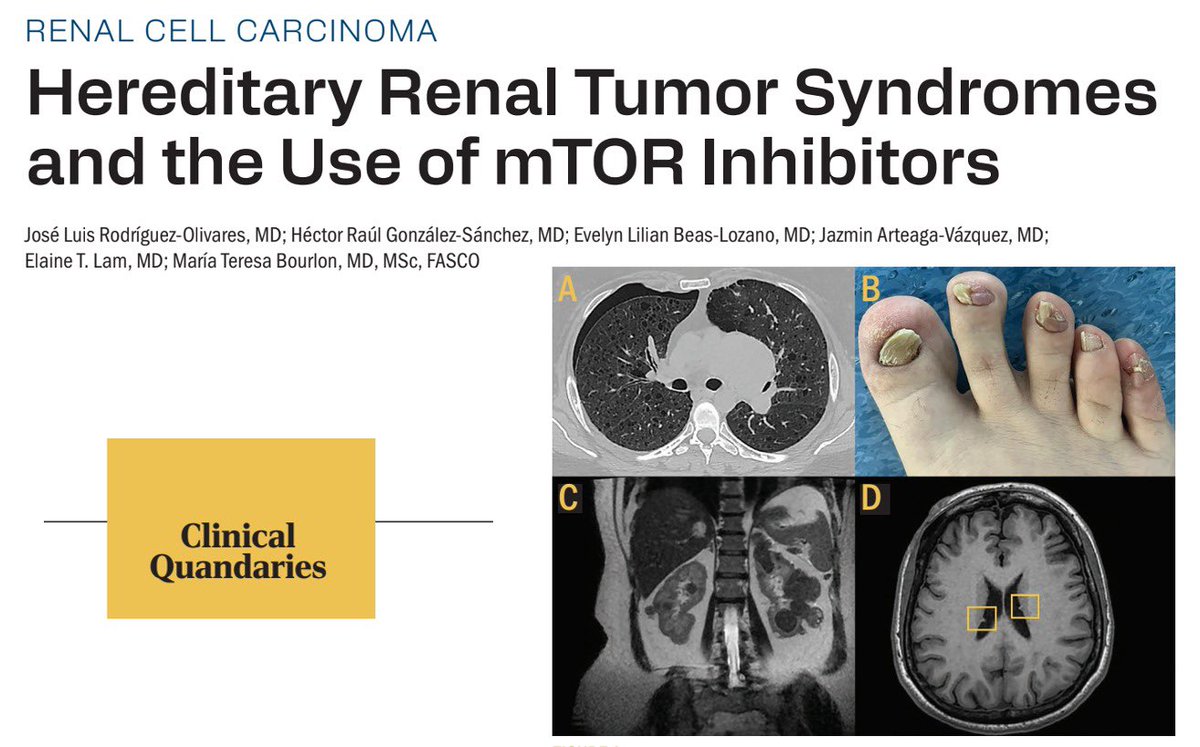 BourlonMaite's tweet photo. Congrats to our fellows for this paper!
@EvelynBeas2 @HeRagosan @JoseLuisROli 

🔵Overview of hereditary cancer syndromes associated w RCC
🟡Recommendations for genetic testing
🟢Tuberous sclerosis complex symptoms and mTOR inhibitors efficacy &amp; safety 

https://t.co/bARRny7eoI https://t.co/1j8x9zVbCY