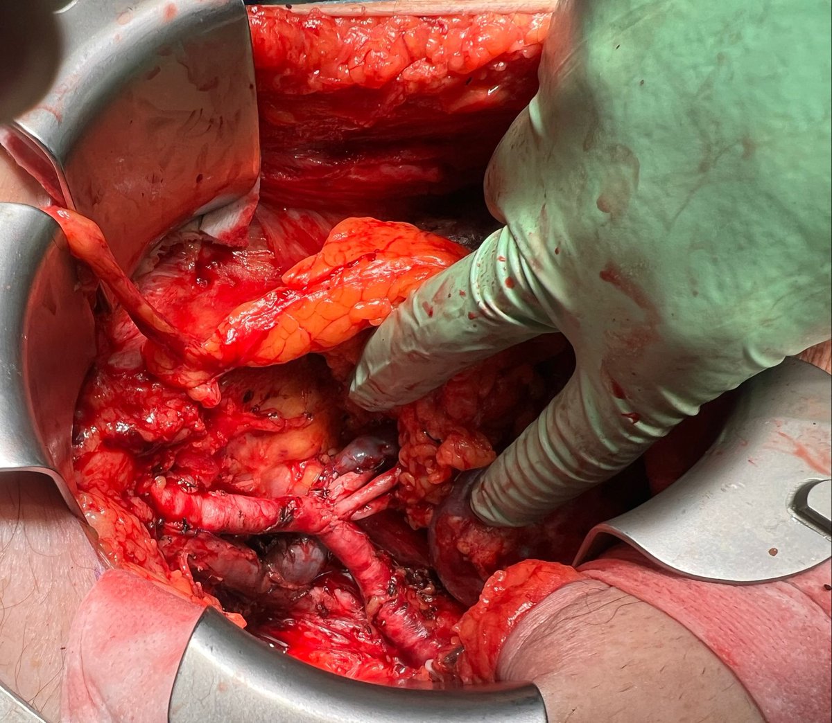 EAU-YAU-Kidney Transplant Working Group (@yau_transplant) on Twitter photo Complex vascular anatomy kidney transplantation. 3 arteries. Side-to-side anastomosis. Would you approach this case the same way? Thank you <a href="/AngeloTerrito/">Angelo Territo</a> for this incredible case. <a href="/FPuigvert/">Fundació Puigvert Barcelona</a> <a href="/AlbertoBreda1/">Alberto Breda</a> <a href="/AlbertoPiana2/">Alberto Piana</a> <a href="/A_LopezAbad/">Alicia Lopez-Abad</a> <a href="/DrBeatrizBM/">Beatriz Bañuelos</a> <a href="/Prudhomme_thom/">Prudhomme Thomas</a> Complex vascular anatomy kidney transplantation. 3 arteries. Side-to-side anastomosis. Would you approach this case the same way? Thank you <a href="/AngeloTerrito/">Angelo Territo</a> for this incredible case. <a href="/FPuigvert/">Fundació Puigvert Barcelona</a> <a href="/AlbertoBreda1/">Alberto Breda</a> <a href="/AlbertoPiana2/">Alberto Piana</a> <a href="/A_LopezAbad/">Alicia Lopez-Abad</a> <a href="/DrBeatrizBM/">Beatriz Bañuelos</a> <a href="/Prudhomme_thom/">Prudhomme Thomas</a>