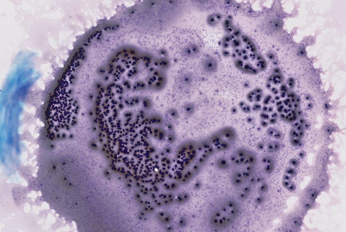 PeterKobalka's tweet image. Pituitary, contents of Rathke’s Cleft Cyst. The colloid-like material really looks like colloid, esp on the Diff-quik! (And maybe some cracking too)
#neuropathology #neuropath #cnspath #pathx #pathtwitter #cytology #cytopath #cytopathology