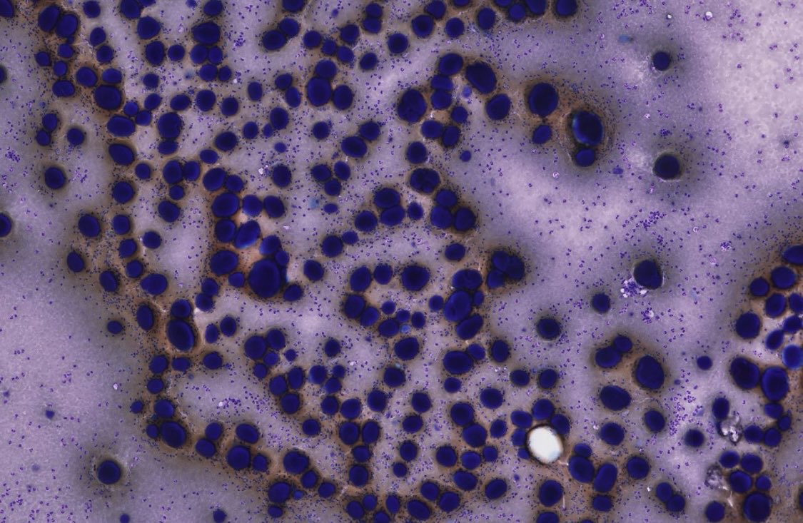 PeterKobalka's tweet image. Pituitary, contents of Rathke’s Cleft Cyst. The colloid-like material really looks like colloid, esp on the Diff-quik! (And maybe some cracking too)
#neuropathology #neuropath #cnspath #pathx #pathtwitter #cytology #cytopath #cytopathology