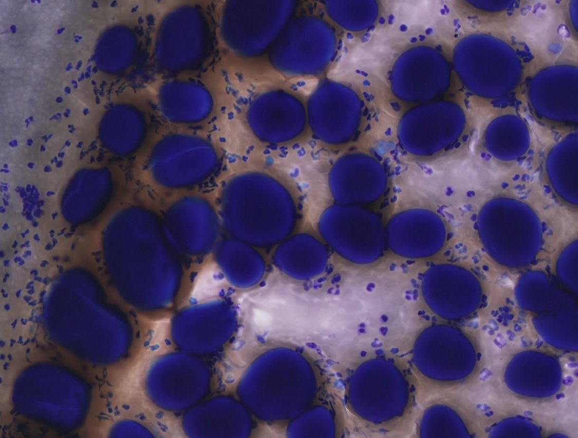 PeterKobalka's tweet image. Pituitary, contents of Rathke’s Cleft Cyst. The colloid-like material really looks like colloid, esp on the Diff-quik! (And maybe some cracking too)
#neuropathology #neuropath #cnspath #pathx #pathtwitter #cytology #cytopath #cytopathology