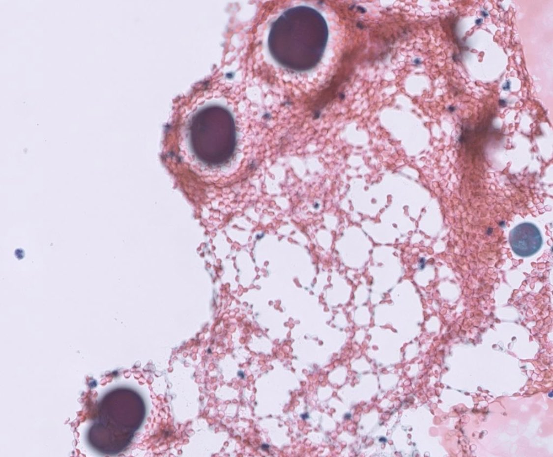 PeterKobalka's tweet image. Pituitary, contents of Rathke’s Cleft Cyst. The colloid-like material really looks like colloid, esp on the Diff-quik! (And maybe some cracking too)
#neuropathology #neuropath #cnspath #pathx #pathtwitter #cytology #cytopath #cytopathology