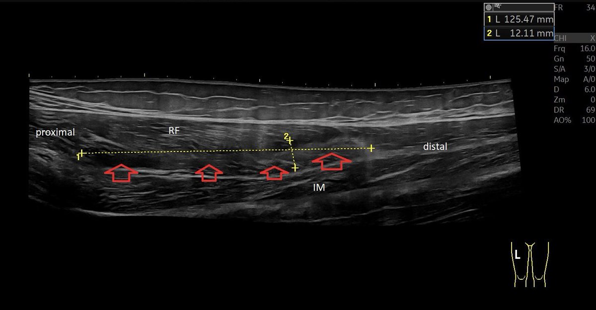SportklinikBern's tweet photo. Posterior myofascial #muscleinjury of the #rectusfemoris - #mskus #pocus #pocushub #GElogiqE10sr4 https://t.co/rj6ZhM5U3E