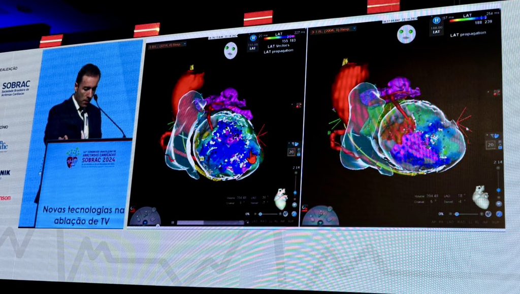 Francisco M. Costa (@moscoso_costa) on Twitter photo Joint session <a href="/SobracO/">SOBRAC</a> <a href="/APAPEletro/">APAPE</a> during #SOBRAC2024. Discussing new technologies in VT ablation.
Fantastic meeting, great discussion!
<a href="/Scanav1Mauricio/">Mauricio Scanavacca</a> <a href="/crpisani/">Cristiano Pisani</a> <a href="/cavaco_diogo/">Diogo Cavaco</a> <a href="/AlexsandroFag18/">Alexsandro Fagundes</a> Joint session <a href="/SobracO/">SOBRAC</a> <a href="/APAPEletro/">APAPE</a> during #SOBRAC2024. Discussing new technologies in VT ablation.
Fantastic meeting, great discussion!
<a href="/Scanav1Mauricio/">Mauricio Scanavacca</a> <a href="/crpisani/">Cristiano Pisani</a> <a href="/cavaco_diogo/">Diogo Cavaco</a> <a href="/AlexsandroFag18/">Alexsandro Fagundes</a>