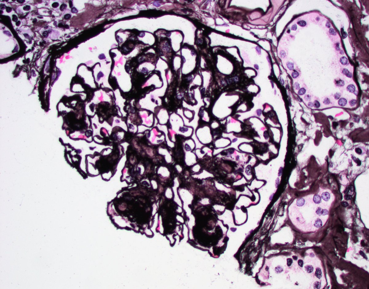 Value of kidney biopsy in diabetic patients. In this case revealed a second diagnosis: ALECT amyloidosis. Amyloid (silver negative) and diabetic nodules (silver +). #renalpath #pathtwitter #nephrology