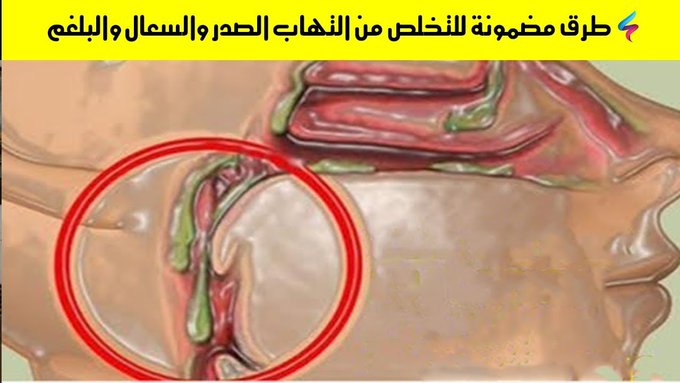 كيفية إزالة البلغم من الحلق 
طرق التخلّص من البلغم نهائيا اشرحها لكم تحت التغريدة ..

لو مشغول فضلها وارجع لها بعدين 🤍