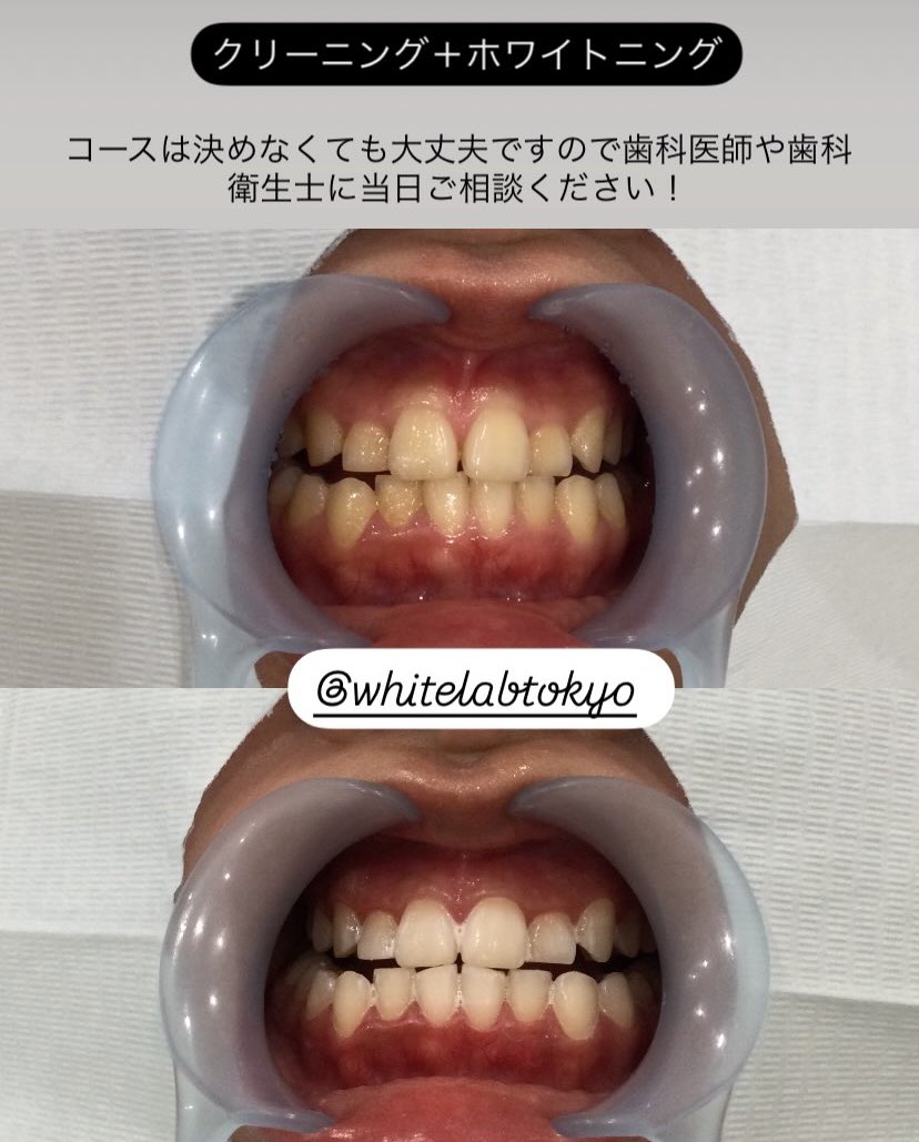 WhiteLabTokyo's tweet photo. #歯を白くしよう
#ホワイトニング
#ホワイトラボ東京
#ブライダルホワイトニング https://t.co/RAkx49uMuS