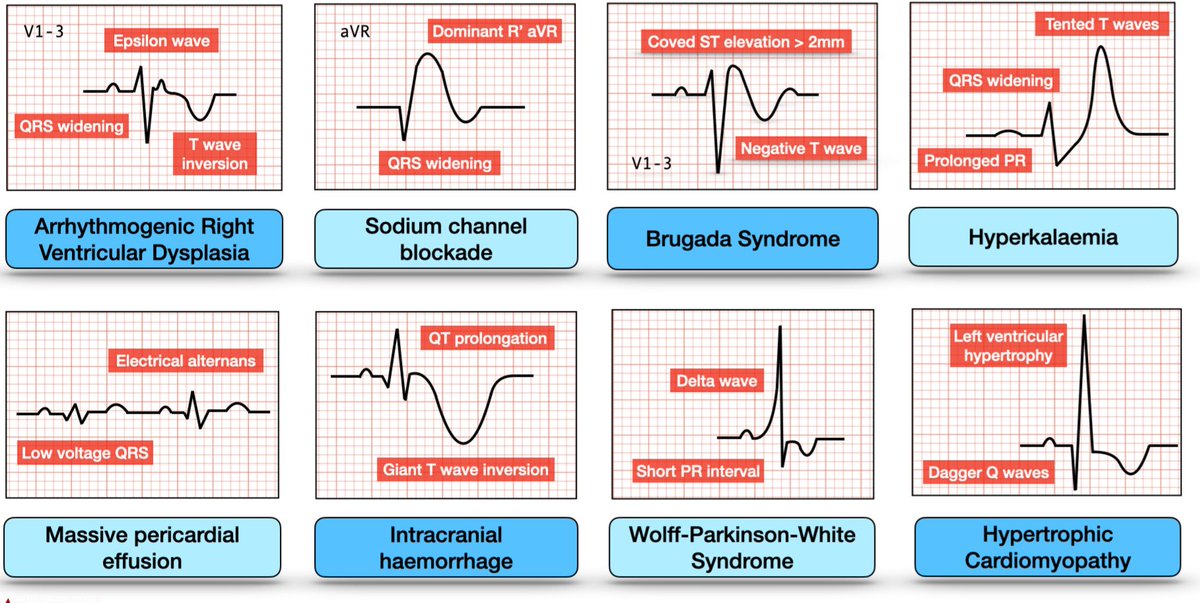 Don't Miss ECG Patterns